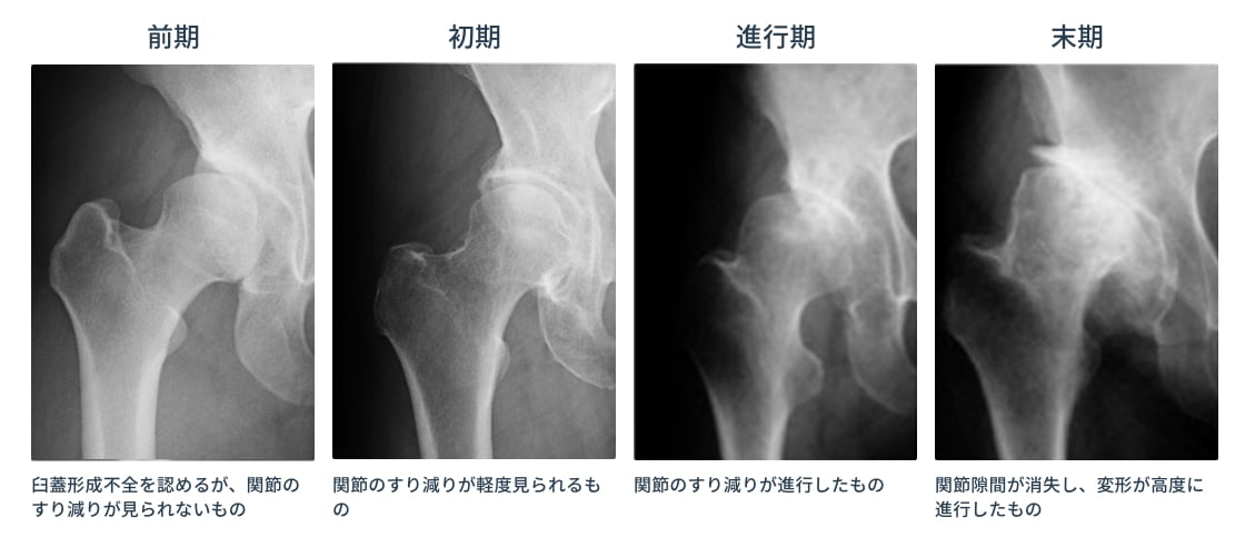 変形性股関節症 | 名古屋整形外科 人工関節クリニック 北名古屋市