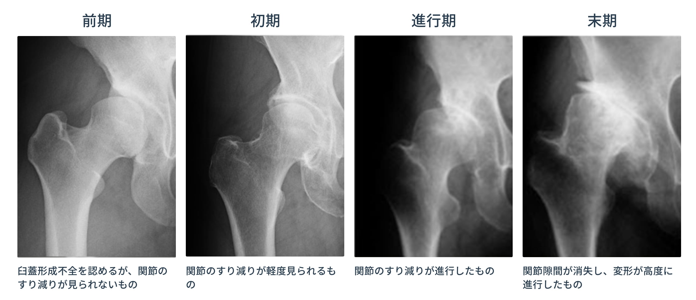 変形性股関節症 名古屋整形外科 人工関節クリニック 北名古屋市