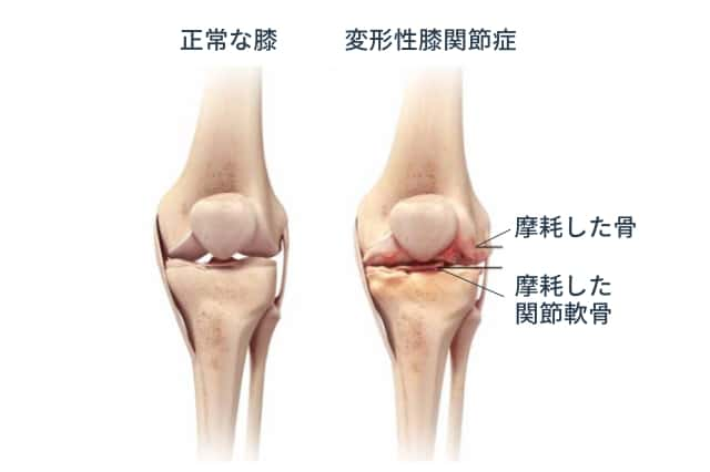 変形性膝関節症 名古屋整形外科 人工関節クリニック 北名古屋市