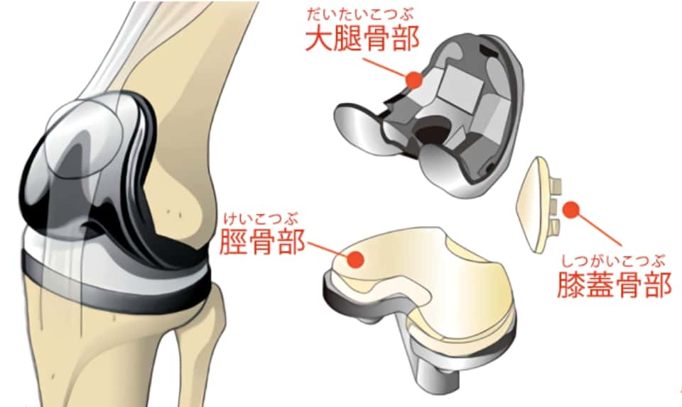 人工 膝 関節 置換 術
